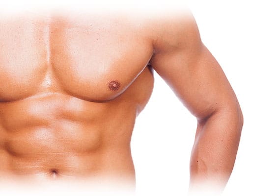 GYNECOMASTIA