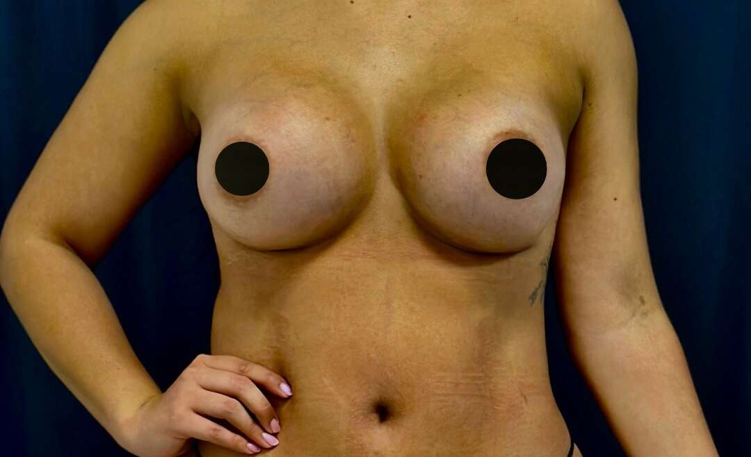 What’s the price of a breast lift and a tummy tuck?